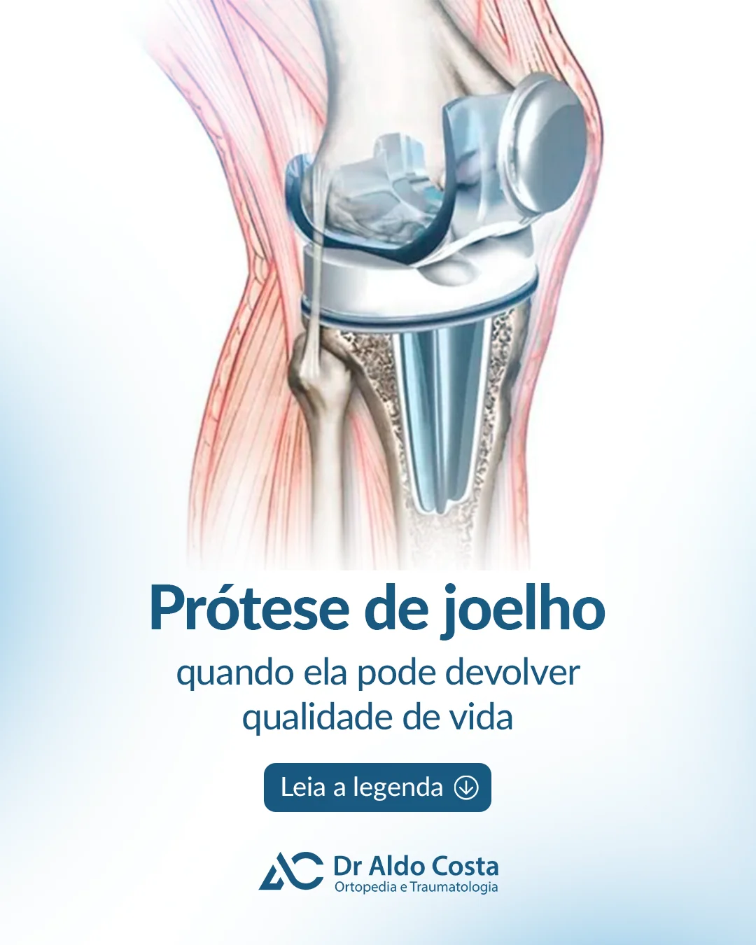 Imagem ilustrativa da notícia: Prótese de joelho, quando ela pode devolver qualidade de vida